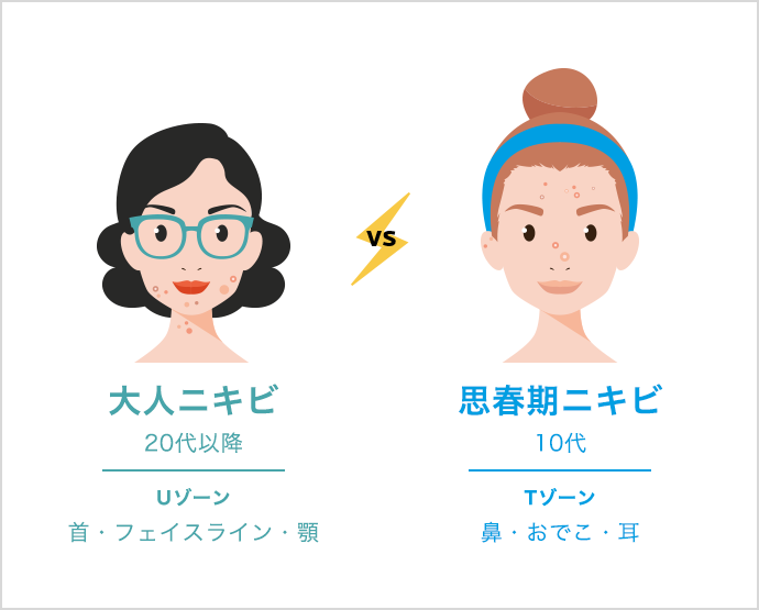 大人ニキビ  20代以降　Uゾーン　首・フェイスライン・顎　思春期ニキビ 10代以降　Tゾーン　鼻・おでこ・耳