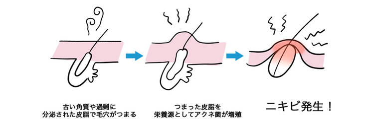古い角質や過剰に 分泌された皮脂で毛穴がつまる つまった皮脂を 栄養源としてアクネ菌が増殖 ニキビ発生!
