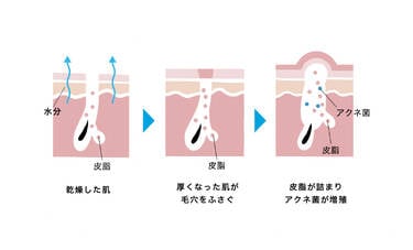 厚くなった角質層が毛穴をふさぐ