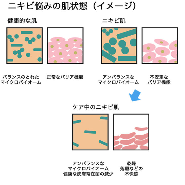 ニキビ悩みの肌状態(イメージ) 健康的な肌 バランスの取れたマイクロバイオーム 正常なバリア機能 ニキビ肌 アンバランスなマイクロバイオーム 不安定なバリア機能 ケア中のニキビ肌 アンバランスなマイクロバイオーム健康な皮膚常在菌の減少 乾燥 落屑などの不快感