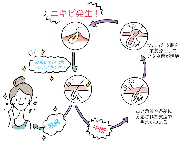 ニキビ発生　皮膚科での治療・正しいスキンケア　継続　正常な毛穴　中断　古い角質や過剰に分泌された皮脂で毛穴がつまる。　詰まった皮脂を栄養源としてアクネ菌が増殖。