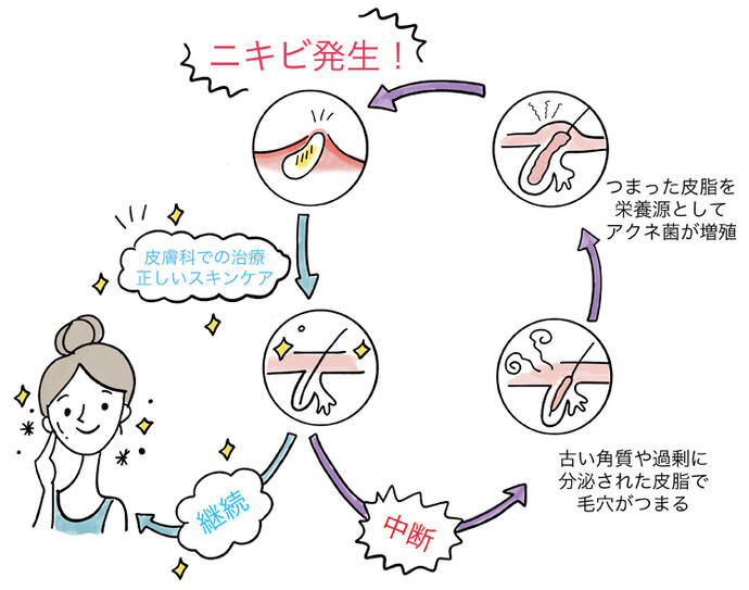 ニキビ発生 皮膚科での治療・正しいスキンケア 継続 正常な毛穴 中断 古い角質や過剰に分泌された皮脂で毛穴がつまる。 詰まった皮脂を栄養源としてアクネ菌が増殖。
