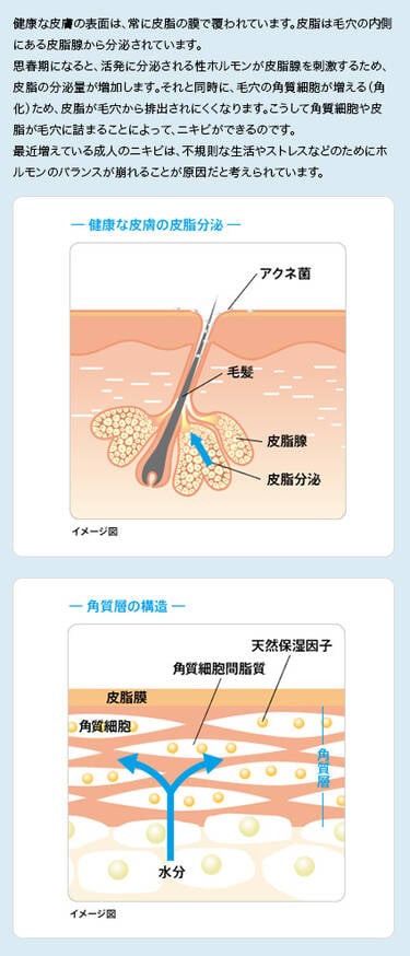ニキビとは