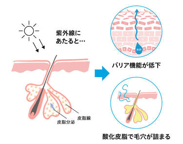 紫外線にあたると… 皮脂腺 皮脂分泌 → バリア機能が低下 酸化皮脂で毛穴が詰まる