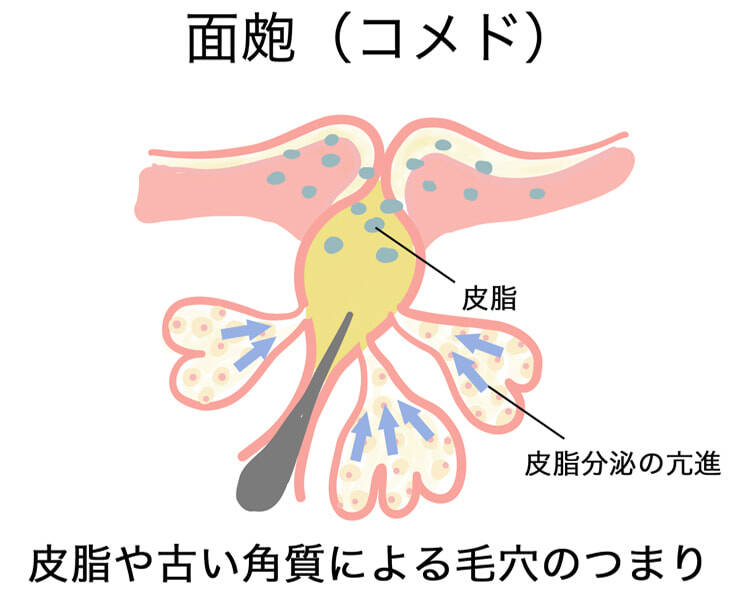 面皰(コメド)皮脂や古い角質による毛穴のつまり
