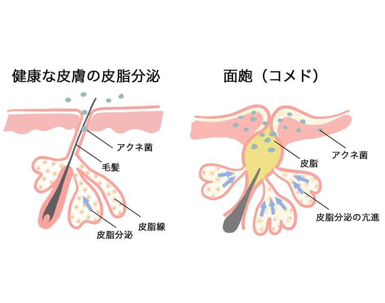 健康的な皮膚の皮脂分泌 面皰(コメド)