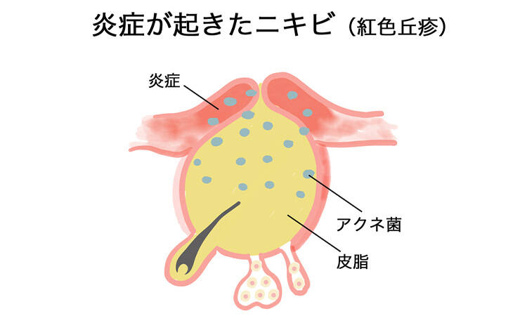 炎症が起きたニキビ(紅色丘疹) 炎症 アクネ菌 皮脂