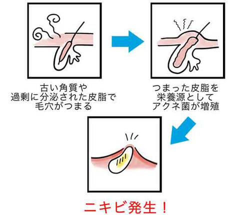 古い角質や過剰に分泌された皮脂で毛穴がつまる つまった皮脂を栄養源としてアクネ菌が増殖 ニキビ発生!