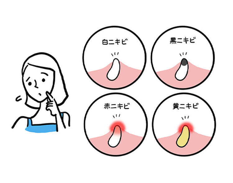 白ニキビ 黒ニキビ 赤ニキビ 黄ニキビ