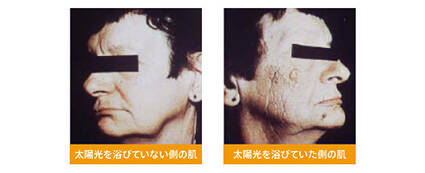 UVAを浴びた肌は弾力を失い、シワやたるみといった肌の老化現状を起こすと考えられています。
