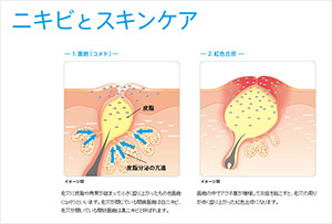 正しいスキンケアを心がけてニキビを予防