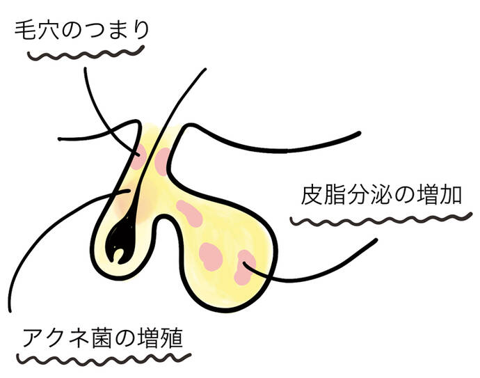 毛穴のつまり アクネ菌の増殖 皮脂分泌の増加