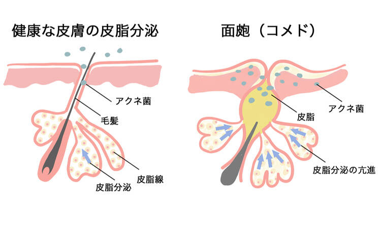 健康な皮膚の皮脂分泌 アクネ菌 毛髪 皮脂腺 皮脂分泌 面皰(コメド) アクネ菌 皮脂 皮脂分泌の亢進