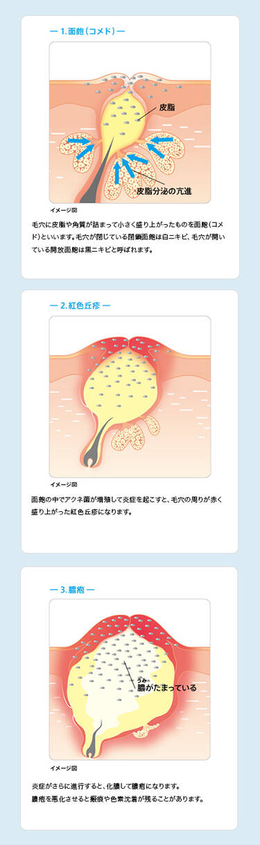 ニキビの症状と出来方