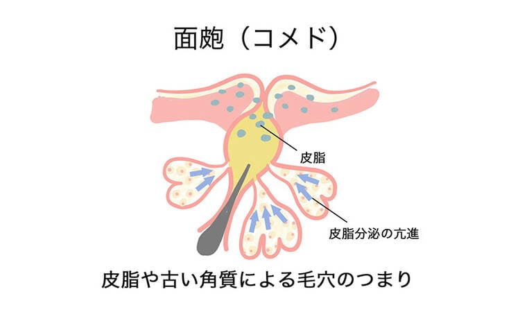 面皰(コメド) 皮脂や古い角質による毛穴のつまり