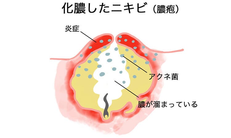 化膿したニキビ(膿疱) 炎症 アクネ菌 膿が溜まっている